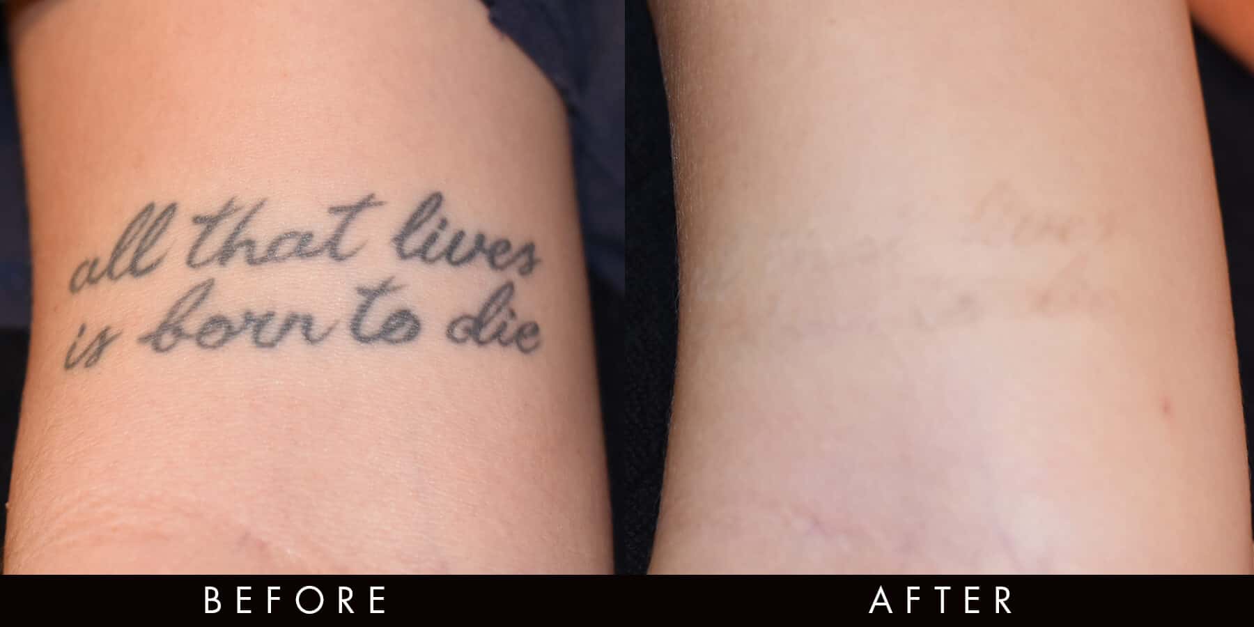 Newcastle tattoo removal