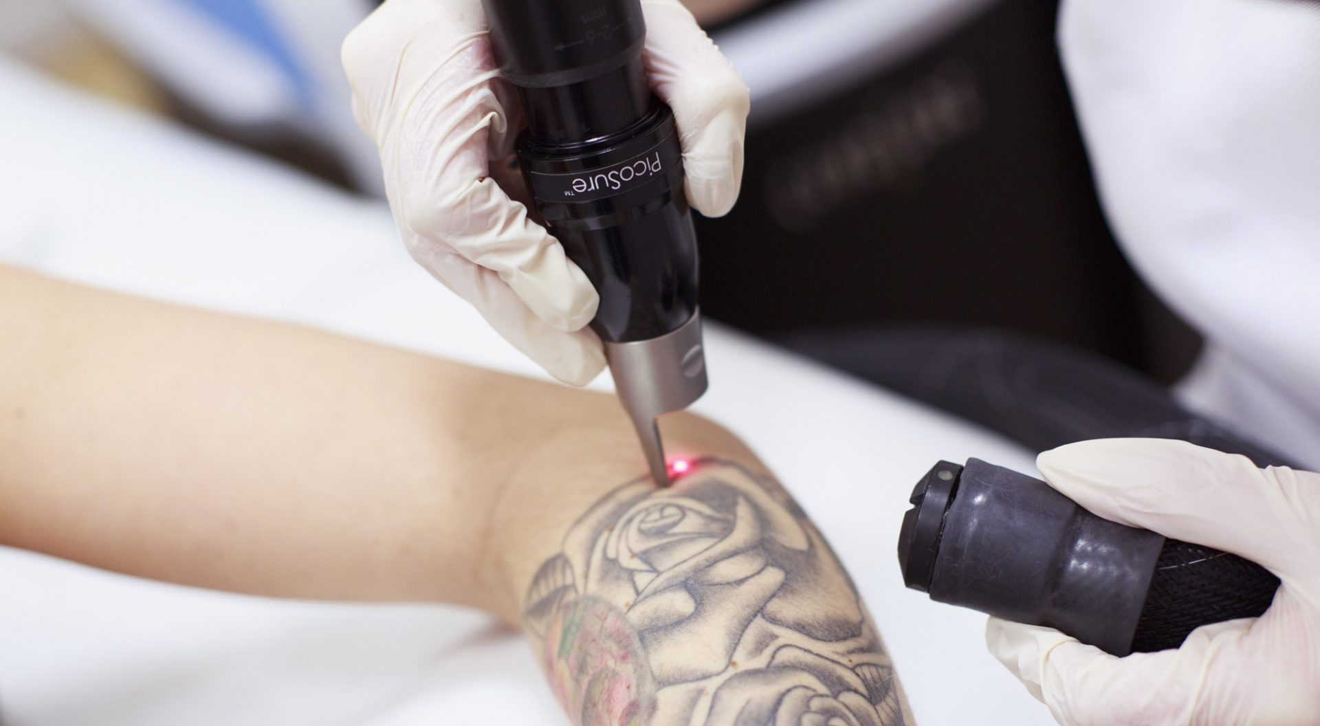 Remove The Tattoo Using The Best Techniques